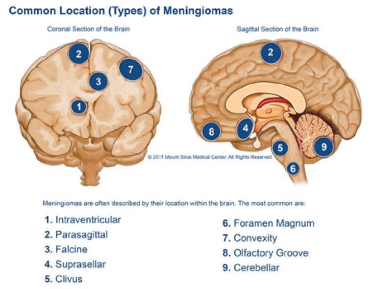 脑膜瘤的种类及位置