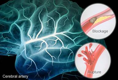 Cerebral Artery