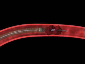 The Penumbra System for mechanical thrombectomy