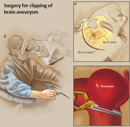 Microsurgery clipping for anterior communicating artery aneurysm