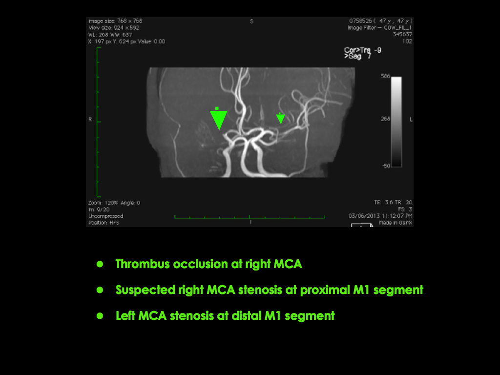 Middle Cerebral Right Artery MCA