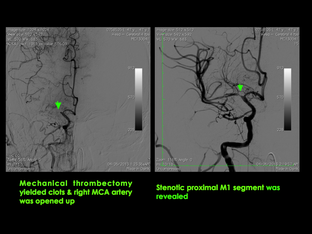 middle-cerebral-artery-MCA4