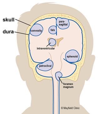 脑膜瘤的位置