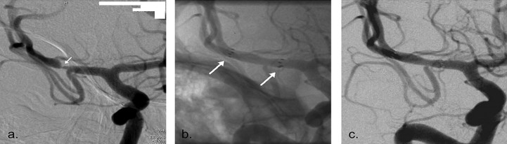 The Pre-stenting Angiogram