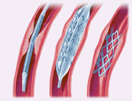 The Wingspan Stent
