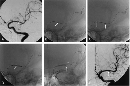 Wingspan stent insertion for middle artery stenosis